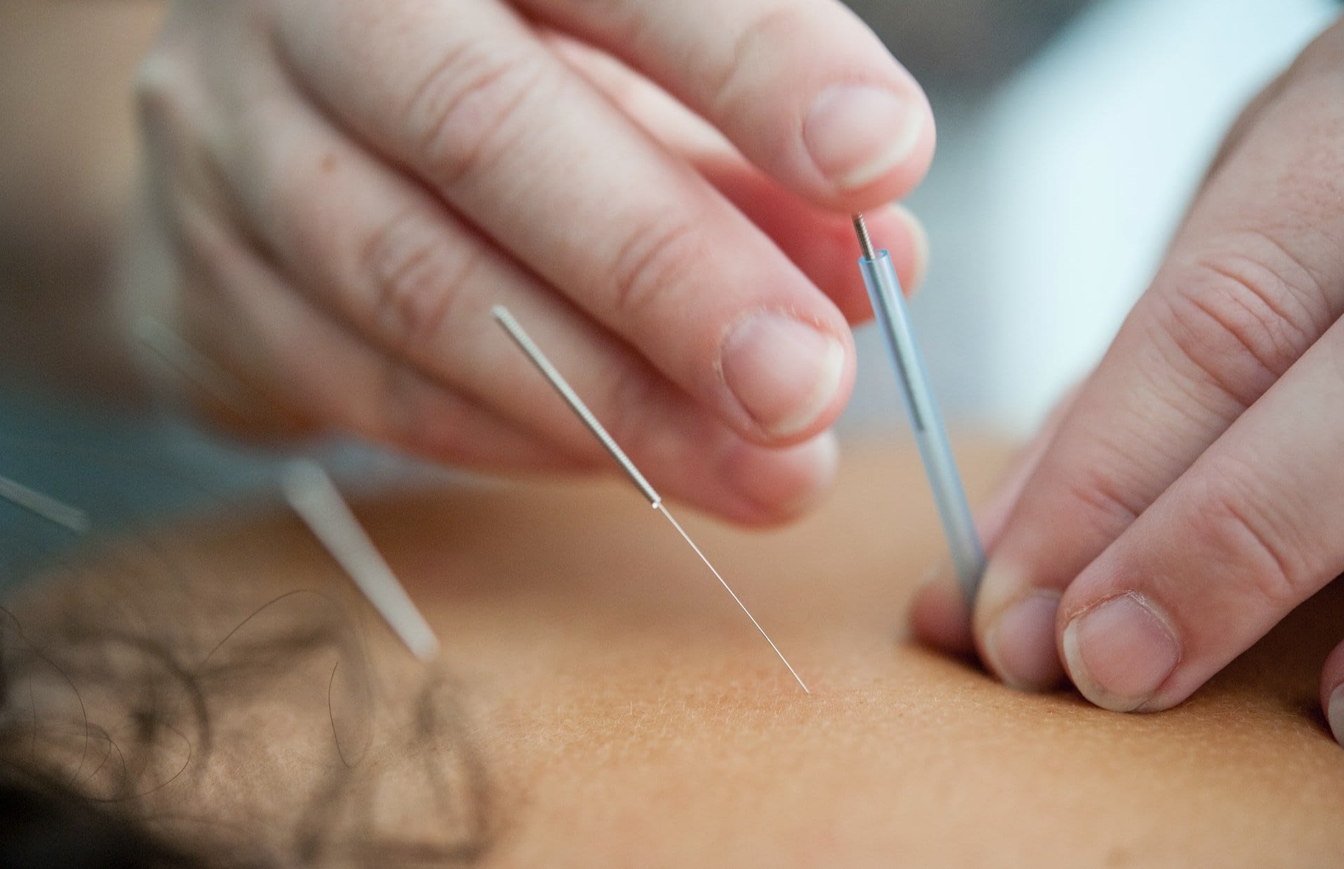 Acupuntura 1 Acupuntura en A Coruña · Clínica Tao Salud Integral Integrativa